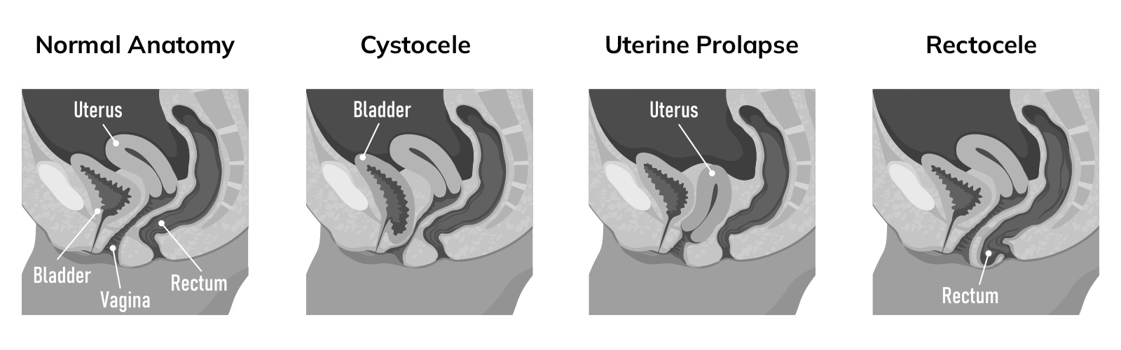 Broken Vaginas – Understanding and healing Maternal Birth Injuries