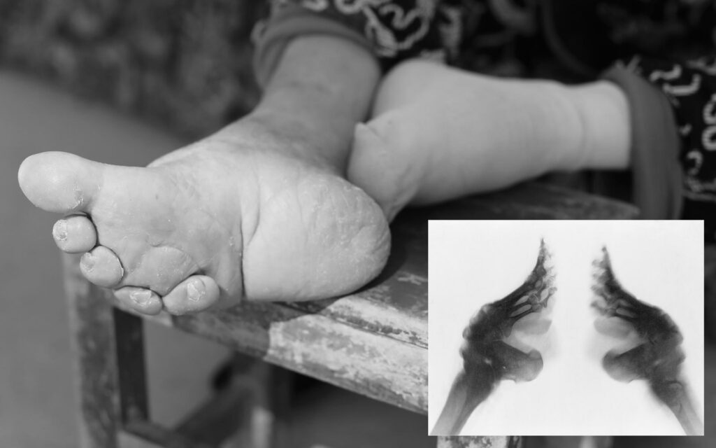Foot binding China